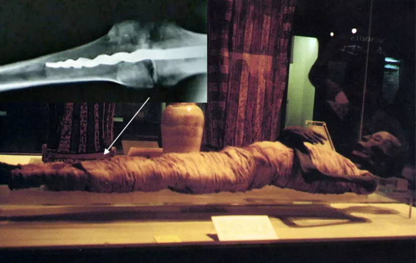 Un tornillo en una rótula de 2600 años.posdata-digital-press